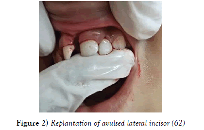dentistry-avulsed-lateral