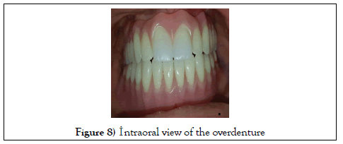 dentistry-case-report-overdenture