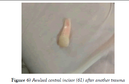 dentistry-central-incisor