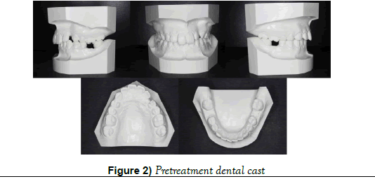 dentistry-dental-cast