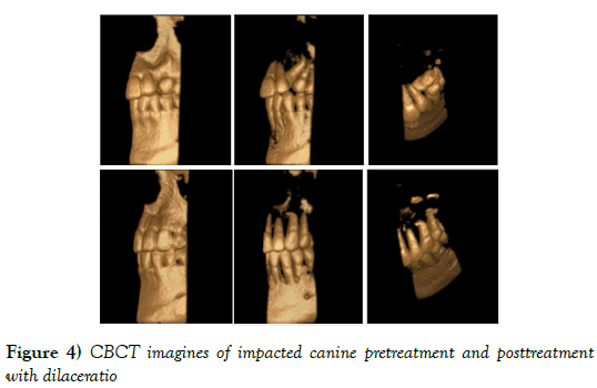 dentistry-impacted-canine