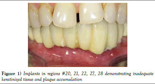 dentistry-inadequate-keratinized