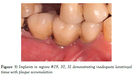 dentistry-inadequate-keratinzed