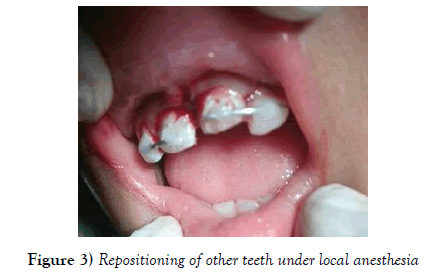 dentistry-local-anesthesia