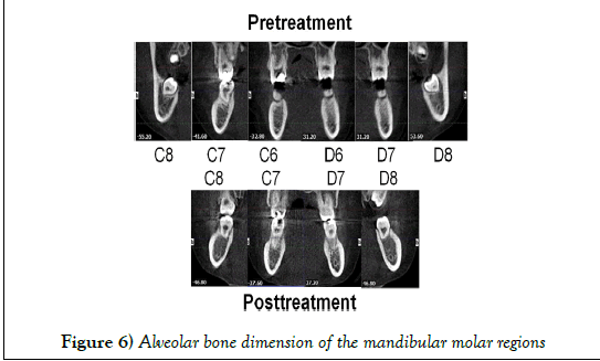 dentistry-mandibular-molar