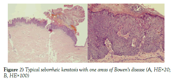 dermatopathology-seborrheic-keratosis