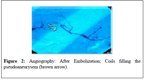 general-surgery-After-embolization