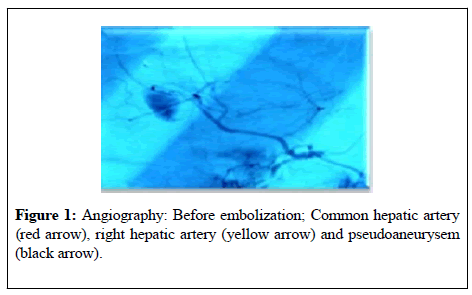 general-surgery-Before-embolization