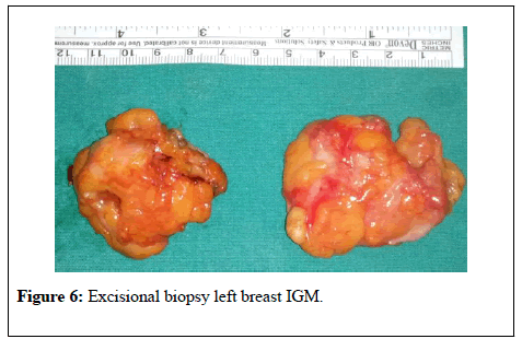 general-surgery-Excisional-biopsy