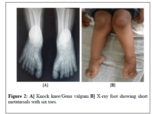 general-surgery-Knock-knee