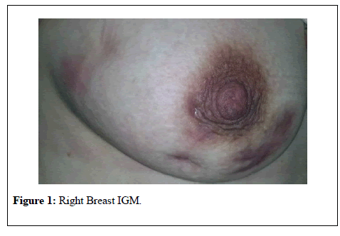 general-surgery-Right-Breast