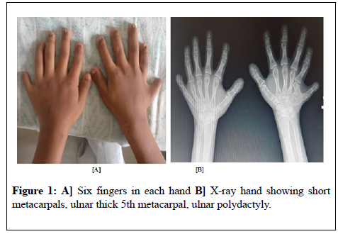 general-surgery-Six-fingers