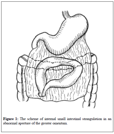 general-surgery-greater-omentum
