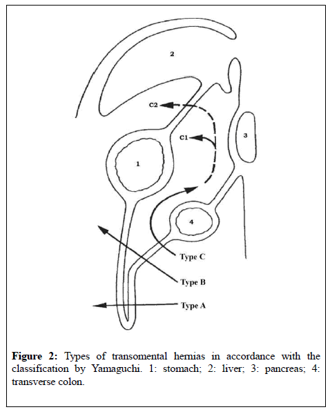 general-surgery-transomental-hernias