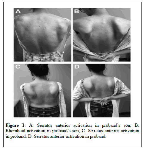 genetic-medicine-Serratus-anterior