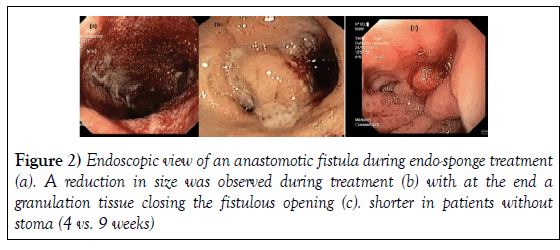 hepatogastroenterology-anastomotic