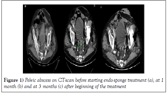 hepatogastroenterology-endo-sponge