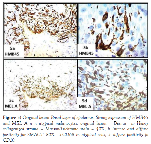 histology-histopathology-research-atypical-melanocytes