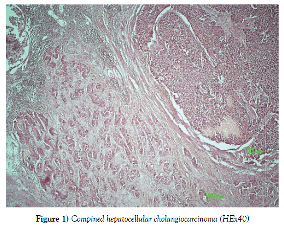 histology-histopathology-research-compined-hepatocellular-cholangiocarcinoma