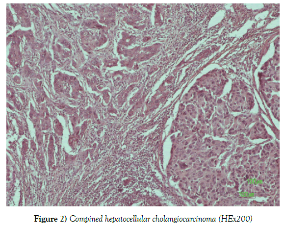 histology-histopathology-research-compined-hepatocellular-cholangiocarcinoma