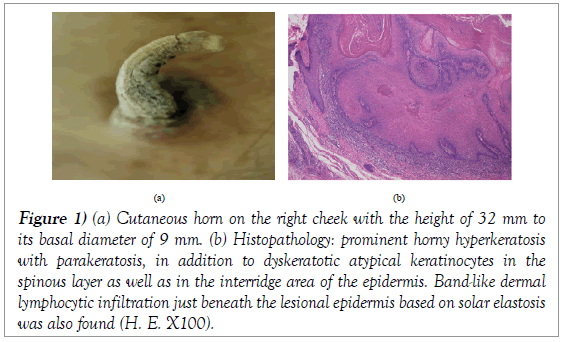 histology-histopathology-research-cutaneous-horn-cheek