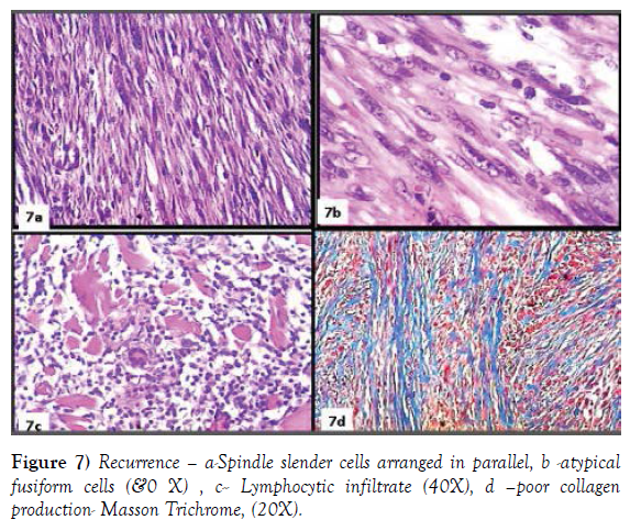 histology-histopathology-research-lymphocytic-infiltrate