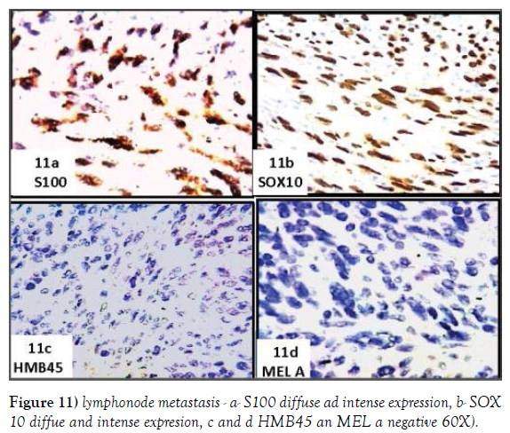 histology-histopathology-research-lymphonode-metastasis