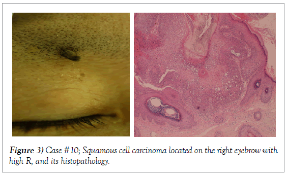 histology-histopathology-research-squamous-cell-carcinoma