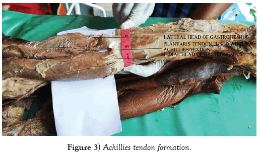 international-journal-anatomical-variations-Achillies-tendon