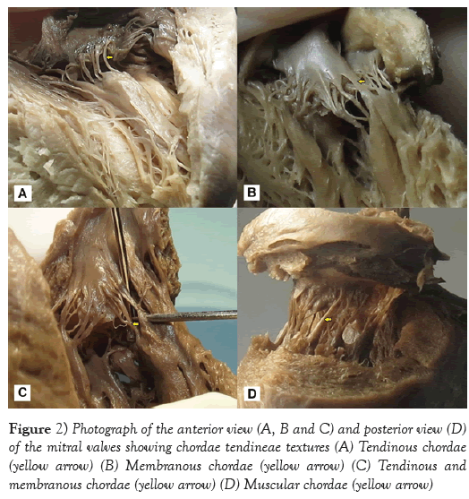 international-journal-anatomical-variations-anterior-view