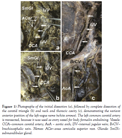 international-journal-anatomical-variations-carotid