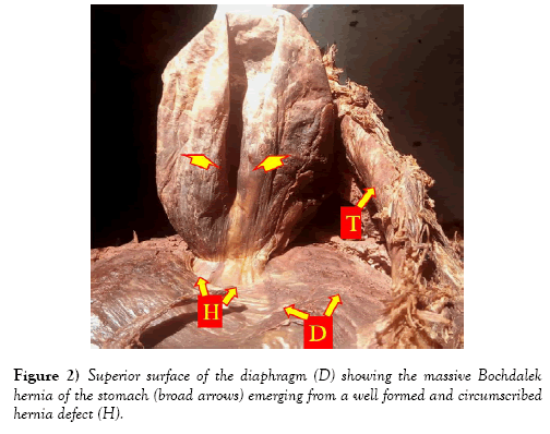 international-journal-anatomical-variations-diaphragm