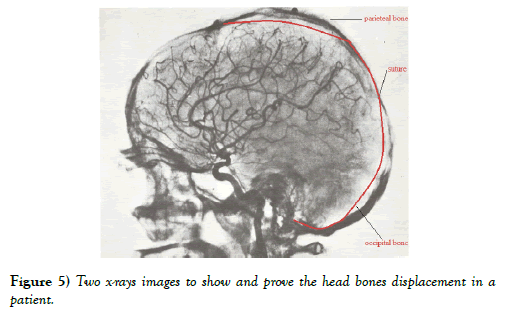 international-journal-anatomical-variations-displacement