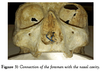 international-journal-anatomical-variations-foramen