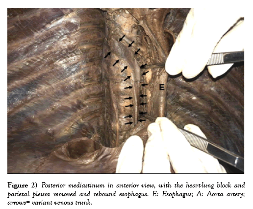 international-journal-anatomical-variations-heart-lung