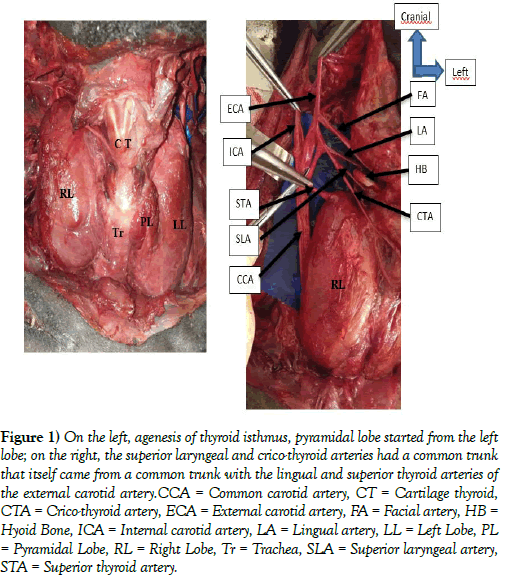 international-journal-anatomical-variations-isthmus