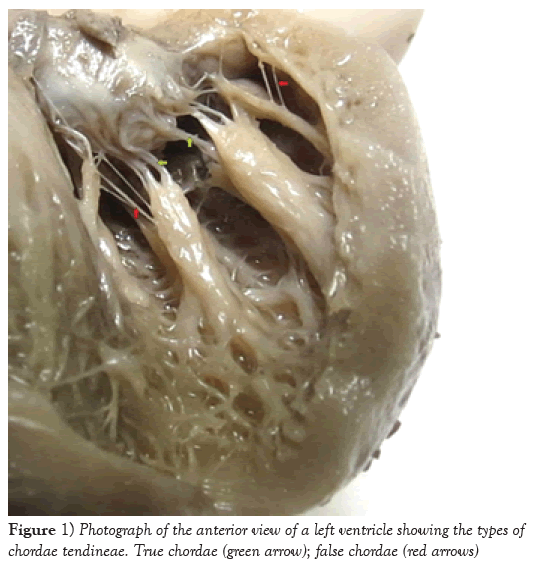 international-journal-anatomical-variations-left-ventricle