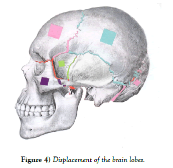 international-journal-anatomical-variations-lobes
