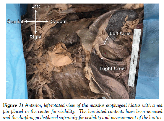 international-journal-anatomical-variations-massive-esophageal