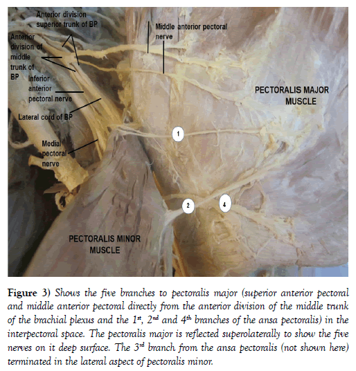 international-journal-anatomical-variations-nerves