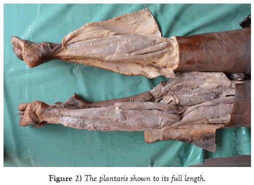 international-journal-anatomical-variations-plantaris