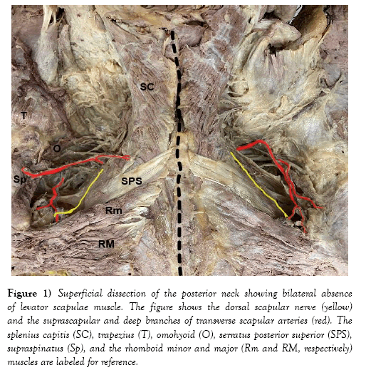 international-journal-anatomical-variations-posterior