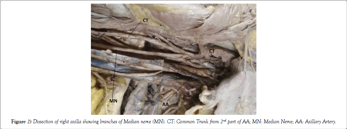 international-journal-anatomical-variations-right-axilla