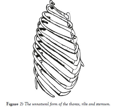 international-journal-anatomical-variations-sternum