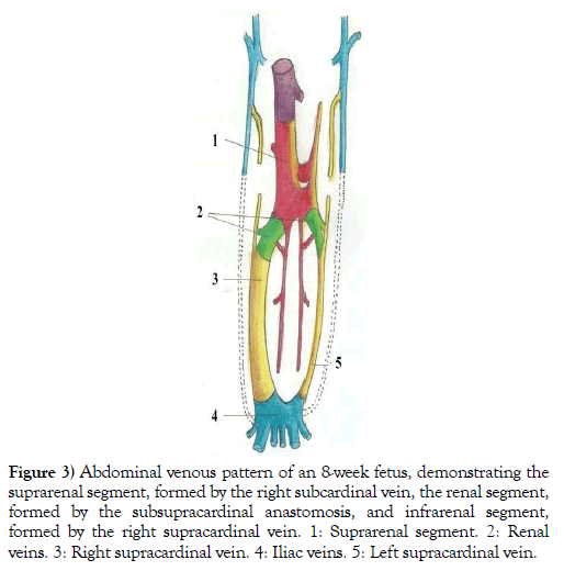 international-journal-anatomical-variations-supracardinal