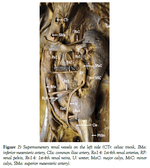 international-journal-anatomical-variations-ureter