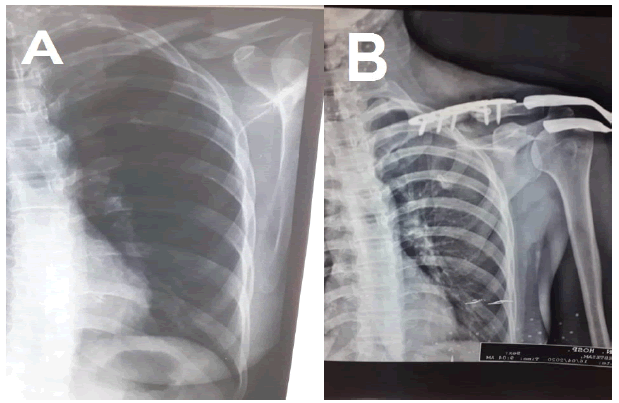 intramuscular-myxoma-atrophic