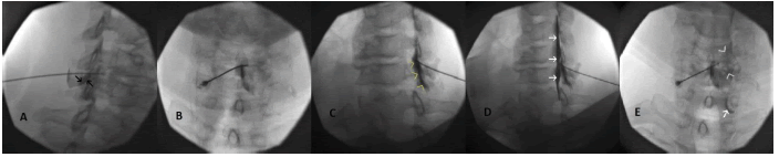 intramuscular-myxoma-contralateral