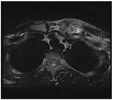 intramuscular-myxoma-discharging