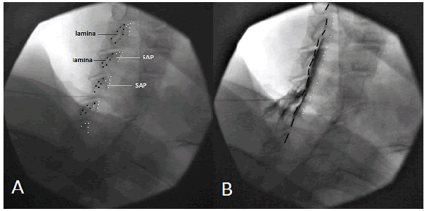 Sterican® deep intramuscular, with long bevel